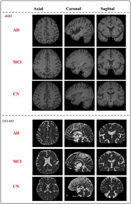 Dominating Alzheimer's disease diagnosis with deep learning on sMRI and DTI-MD